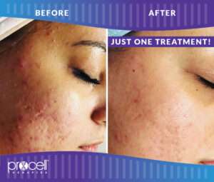 ProCellAcneScars_B&A_OneTreatment-002