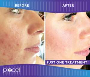 ProCellAcneScars_B_A_OneTreatment-001