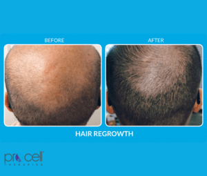 hairregrowthprocell